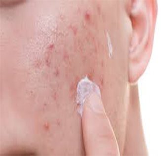 Acne (pimples) Treatment